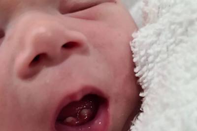 Девочка родилась сразу с тремя зубами и удивила родителей и врачей