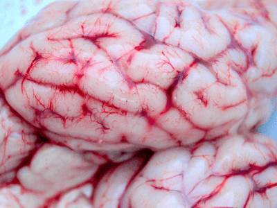 Ученые заявили, что сотрясение мозга повышает риск развития болезни Паркинсона и деменции - live24.ru - Канада