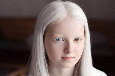 Чеченка-альбинос с гетерохромией стала звездой Сети