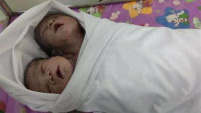 В Мьянме родился ребенок с двумя головами