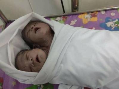 Жительница Мьянмы родила ребенка с двумя головами