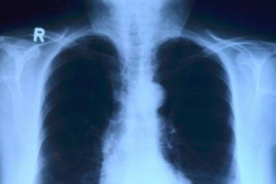 Число случаев пневмоний снова растет в Псковской области