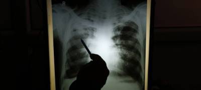 Пять пациентов с внебольничной пневмонией госпитализированы за сутки в Карелии