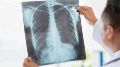 27 человек заболели пневмонией за сутки в Казахстане