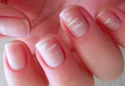 Медики объяснили, о чем свидетельствуют белые пятна на ногтях