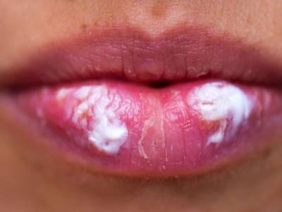 Можно потерять слух и зрение: Врач рассказал об опасных последствиях «простуды» на губах