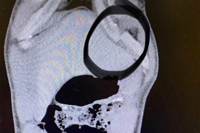 Снимок сломанного ребра бывшего чемпиона UFC испугал пользователей сети