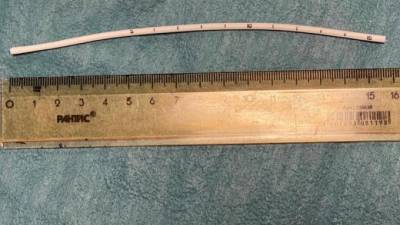В Елизаветинской больнице пенсионерке через вену достали 16-сантиметровый катетер