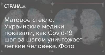 Матовое стекло. Украинские медики показали, как Covid-19 шаг за шагом уничтожает легкие человека. Фото
