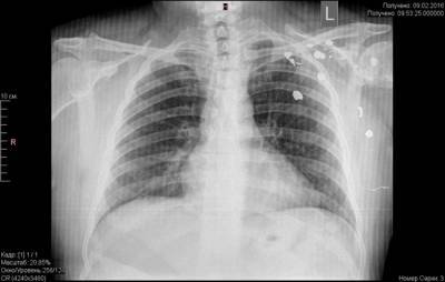 В крупные больницы Прикамья до 1 января закупят мобильные рентгеновские аппараты