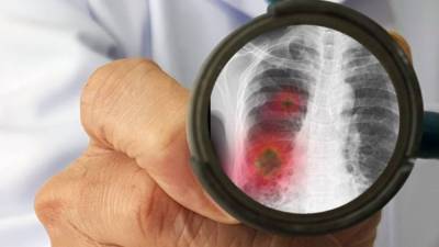 Резко снизилось число выявленных случаев пневмонии за сутки в Казахстане