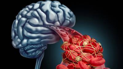 Невролог назвал первые и неочевидные симптомы инсульта