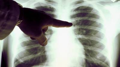 Еще снизилось число выявленных случаев пневмонии в Казахстане