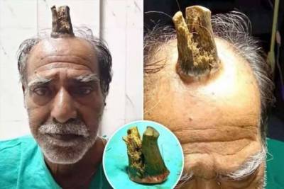 В Индии врачи удалили мужчине 10-сантиметровый рог