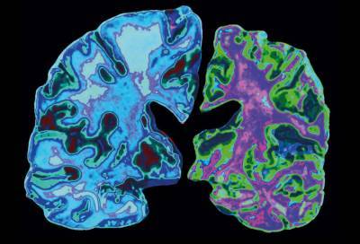 Ученые обнаружили способ предотвратить неизлечимую болезнь мозга