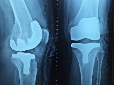 Учёные выяснили, почему при остеоартрите люди испытывают разную боль