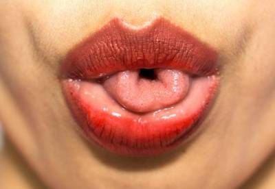 Врачи назвали красный язык симптомом опасной болезни
