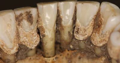 Зубной камень может раскрыть пристрастие древних людей к наркотикам