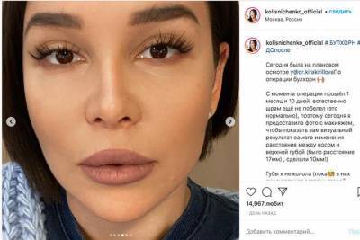 Катя Колисниченко показала результат очередной пластики лица