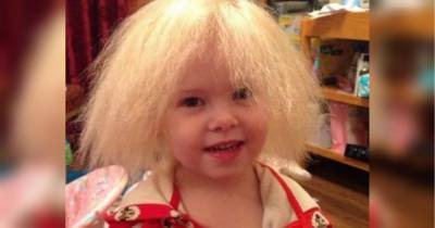 "Альберт Эйнштейн": девочке со "стекловидными волосами" исполнилось девять лет