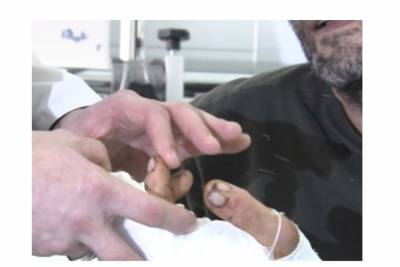 Краснодарские хирурги спасли столяра с распиленной рукой