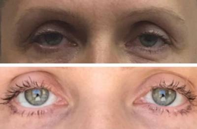 Женщина после операции проснулась с разными глазами