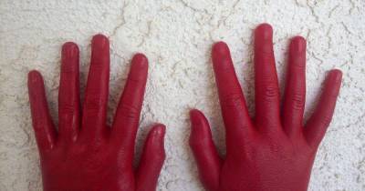 Красные руки назвали симптомом опасной болезни печени