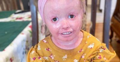 Девочка с редким синдромом и ярко-розовой кожей стала звездой Instagram