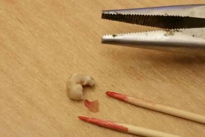 Мужчина боялся идти к стоматологу и вырвал себе зуб плоскогубцами