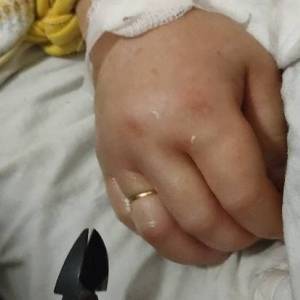 В Запорожье спасатели помогли женщине в реанимации, освободив напухший палец от кольца. Видео