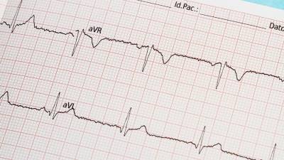 Терапевт назвала нетипичный признак инфаркта миокарда