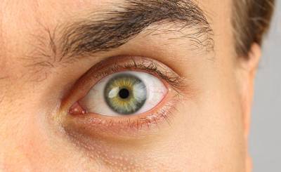 Haber7 (Турция): как убрать синяки под глазами? Натуральные средства лечения