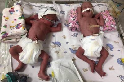 В Ужгороде беременной четверней девушке сделали уникальное кесарево сечение: фото младенцев