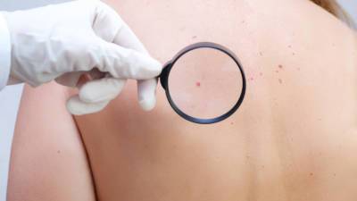 Онколог рассказал о нетипичных симптомах рака кожи