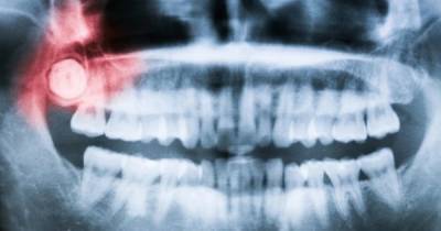 Ученые выяснили, почему у людей растут зубы мудрости во взрослом возрасте