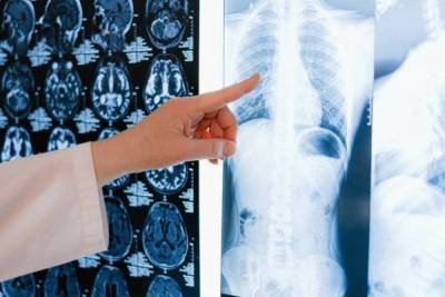 Британские врачи назвали неочевидный симптом рака легких