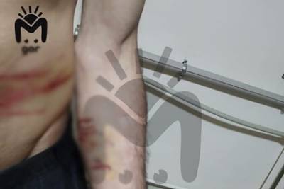 Опубликованы фото со следами избиений на устроивших бунт российских заключенных