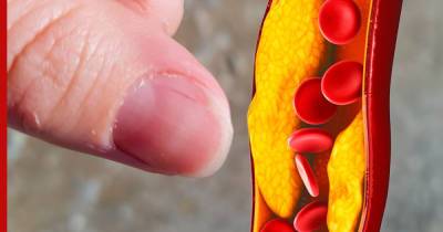 Высокий холестерин: один признак на ногтях укажет на опасное состояние