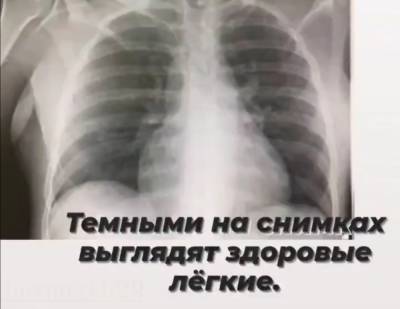 Главврач нижегородской больницы наглядно показала, чем опасен COVID-19 для легких