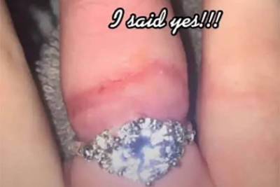 Распухший палец на фото хваставшейся кольцом девушки испугал пользователей сети
