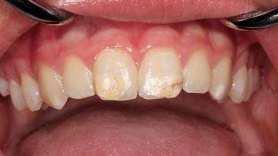 Эта болезнь эмали зубов встречается все чаще: что нужно знать