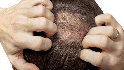 Ученые связали облысение с утратой липкости волос