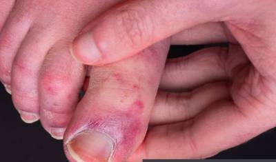 Врачи в Британии заявили, что обморожение пальцев похоже на ещё один симптом COVID