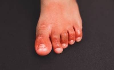 Ученые обнаружили новый симптом COVID, напоминающий обморожения ног (фото)