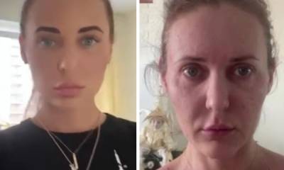 За месяц постарела на 10 лет: девушка рассказала, как косметолог испортила ей внешность