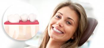Современные зубные импланты – это прекрасная альтернатива протезам