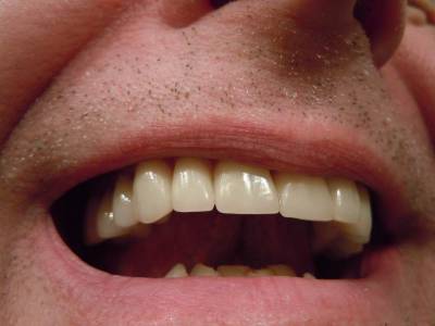 Ученые раскрыли механизм появления зубов мудрости
