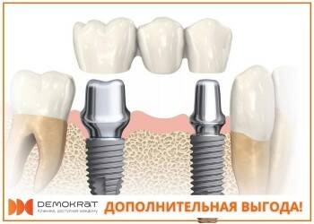 Лечите и восстанавливайте зубы выгодно в стоматологии «Демократ»!