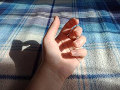 Распознать повреждение печени помогают признаки на ногтях и ладонях