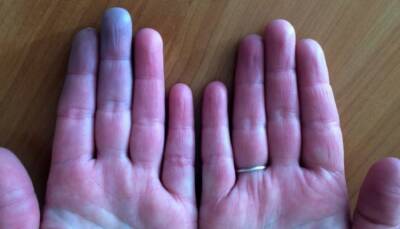 После перенесенного COVID-19 кончики пальцев становятся фиолетовыми